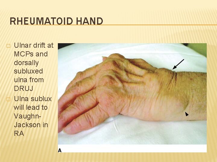 RHEUMATOID HAND � � Ulnar drift at MCPs and dorsally subluxed ulna from DRUJ