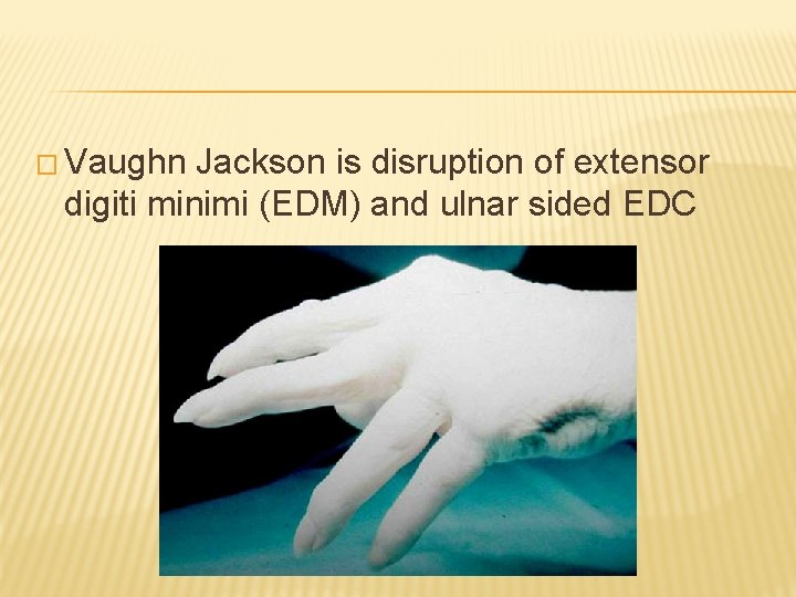 � Vaughn Jackson is disruption of extensor digiti minimi (EDM) and ulnar sided EDC