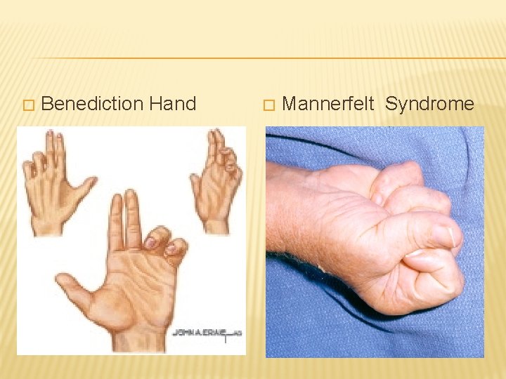 � Benediction Hand � Mannerfelt Syndrome 