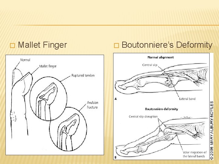 � Mallet Finger � Boutonniere’s Deformity 