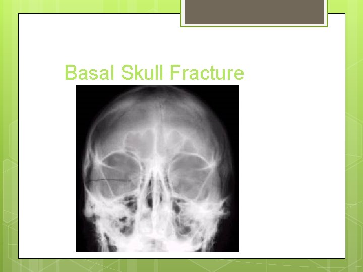Basal Skull Fracture 