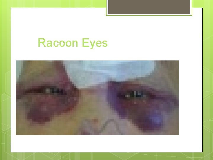 Racoon Eyes 