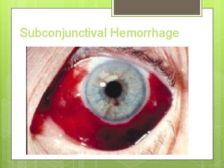 Subconjunctival Hemorrhage 