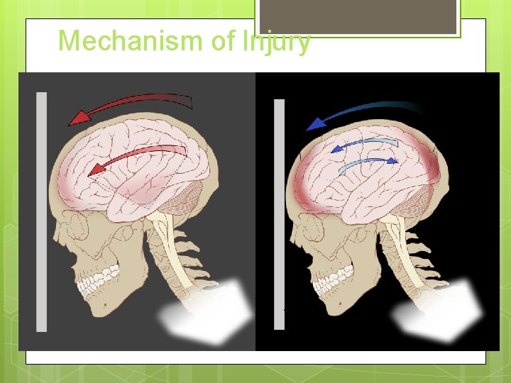 Mechanism of Injury 