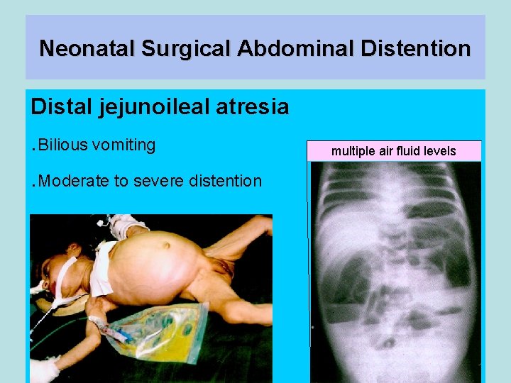 Neonatal Surgical Abdominal Distention Distal jejunoileal atresia . Bilious vomiting. Moderate to severe distention