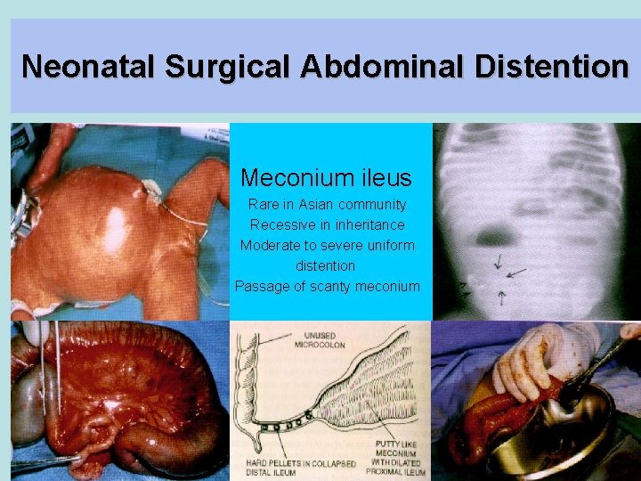 Neonatal Surgical Abdominal Distention Meconium ileus Rare in Asian community Recessive in inheritance Moderate