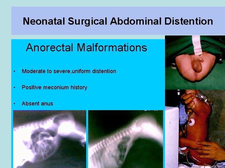 Neonatal Surgical Abdominal Distention Anorectal Malformations • Moderate to severe, uniform distention • Positive