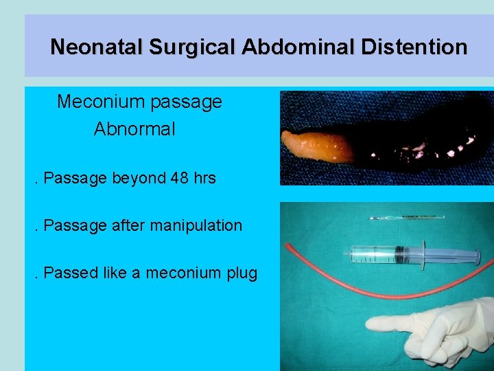 Neonatal Surgical Abdominal Distention Meconium passage Abnormal. Passage beyond 48 hrs. Passage after manipulation.