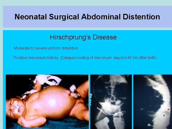 Neonatal Surgical Abdominal Distention Hirschprung’s Disease Moderate to severe uniform distention Positive meconium history