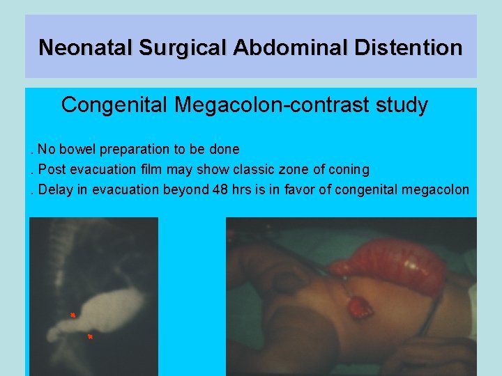 Neonatal Surgical Abdominal Distention Congenital Megacolon-contrast study. No bowel preparation to be done. Post