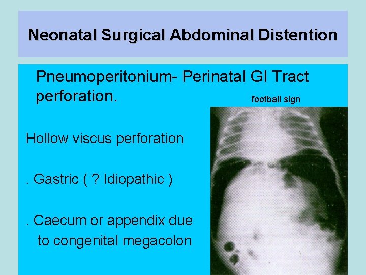 Neonatal Surgical Abdominal Distention Pneumoperitonium- Perinatal GI Tract perforation. football sign Hollow viscus perforation.