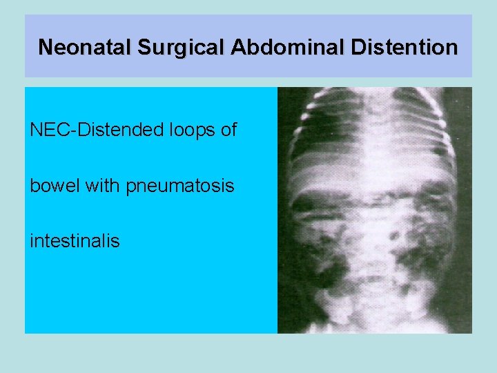 Neonatal Surgical Abdominal Distention NEC-Distended loops of bowel with pneumatosis intestinalis 