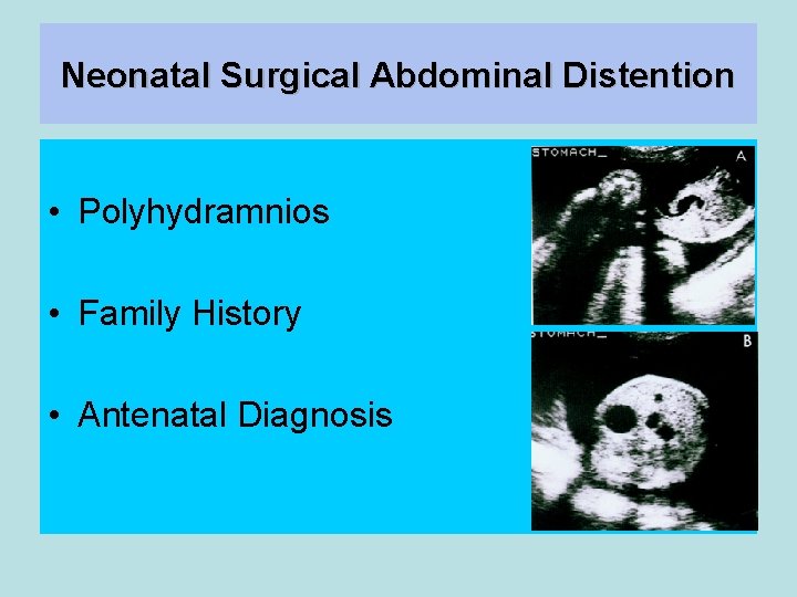 Neonatal Surgical Abdominal Distention • Polyhydramnios • Family History • Antenatal Diagnosis 