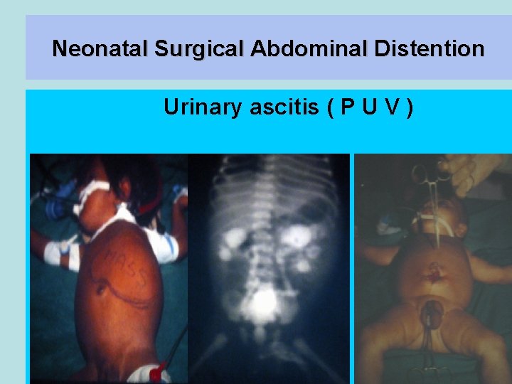 Neonatal Surgical Abdominal Distention Urinary ascitis ( P U V ) 