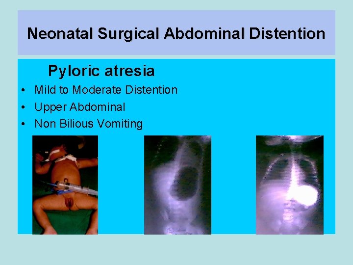 Neonatal Surgical Abdominal Distention Pyloric atresia • Mild to Moderate Distention • Upper Abdominal