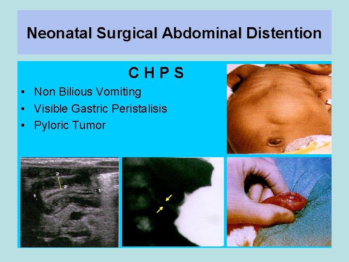 Neonatal Surgical Abdominal Distention CHPS • Non Bilious Vomiting • Visible Gastric Peristalisis •