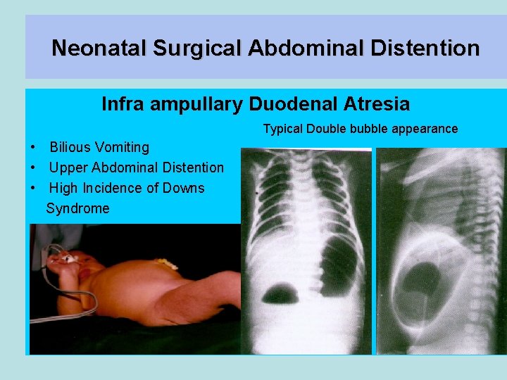Neonatal Surgical Abdominal Distention Infra ampullary Duodenal Atresia Typical Double bubble appearance • Bilious