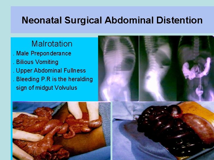 Neonatal Surgical Abdominal Distention Malrotation. Male Preponderance. Bilious Vomiting. Upper Abdominal Fullness. Bleeding P.
