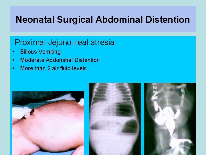 Neonatal Surgical Abdominal Distention Proximal Jejuno-ileal atresia • Bilious Vomiting • Moderate Abdominal Distention