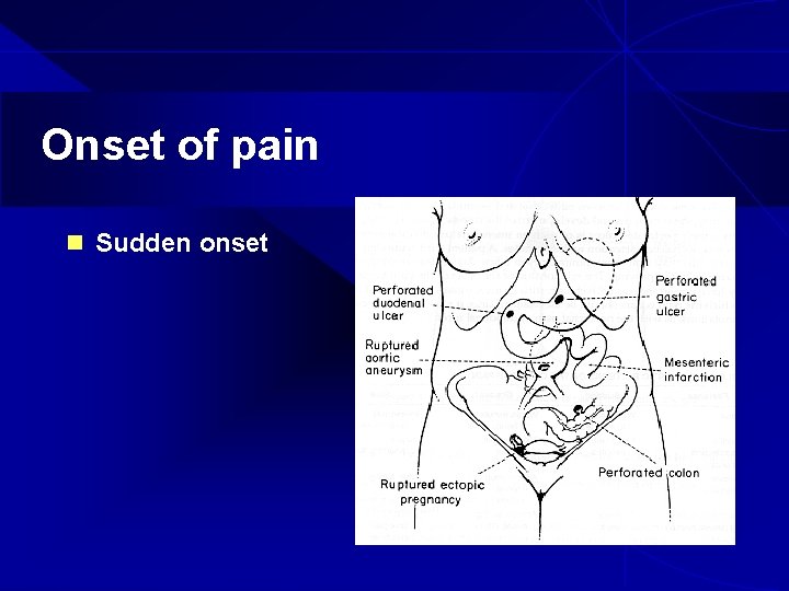 Onset of pain n Sudden onset 