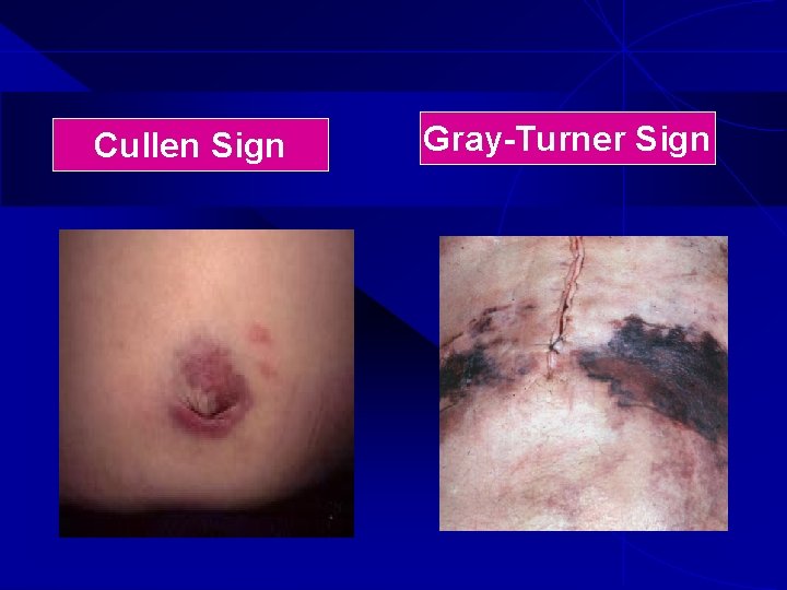 Cullen Sign Gray-Turner Sign 
