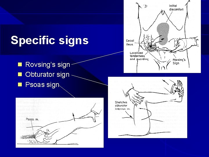 Specific signs n Rovsing’s sign n Obturator sign n Psoas sign 