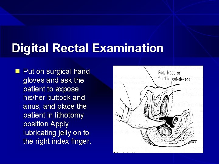 Digital Rectal Examination n Put on surgical hand gloves and ask the patient to
