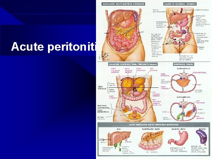 Acute peritonitis 