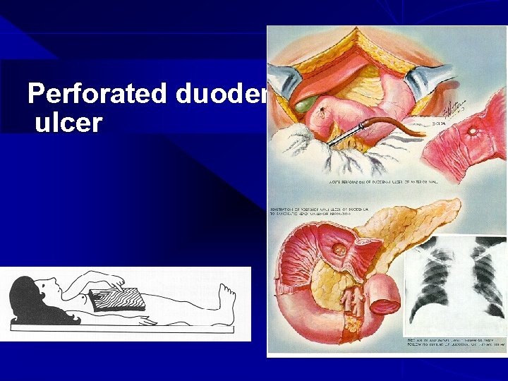 Perforated duodenal ulcer 