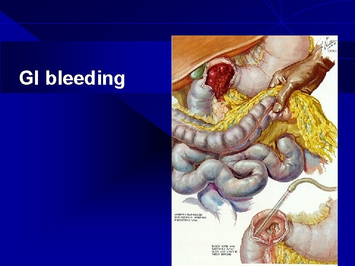 GI bleeding 