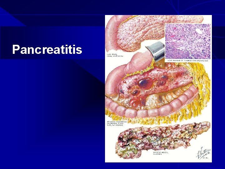 Pancreatitis 