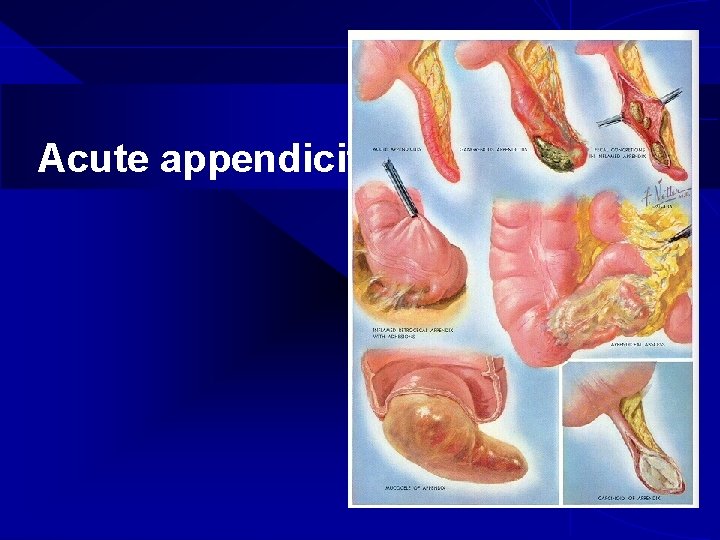 Acute appendicitis 