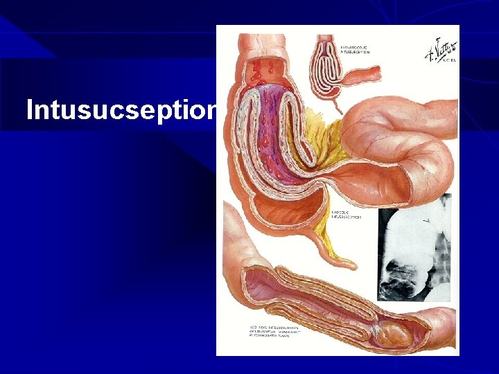 Intusucseption 