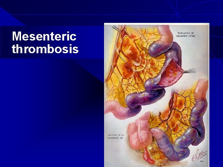 Mesenteric thrombosis 