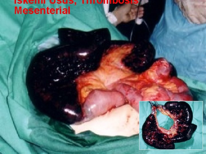 Iskemi Usus, Thrombosis Mesenterial 