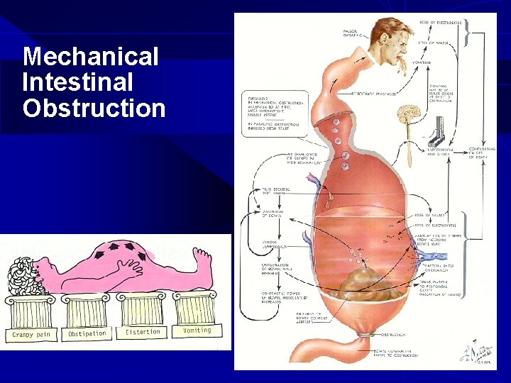 Mechanical Intestinal Obstruction 