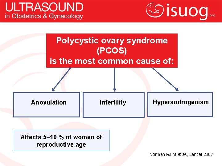 Polycystic ovary syndrome (PCOS) is the most common cause of: Anovulation Infertility Hyperandrogenism Affects