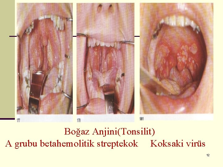 Boğaz Anjini(Tonsilit) A grubu betahemolitik streptekok Koksaki virüs 12 