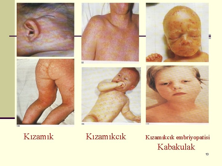 Kızamıkcık embriyopatisi Kabakulak 13 