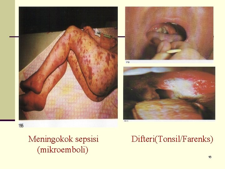 Meningokok sepsisi (mikroemboli) Difteri(Tonsil/Farenks) 16 