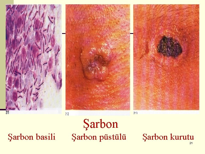 Şarbon basili Şarbon püstülü Şarbon kurutu 21 