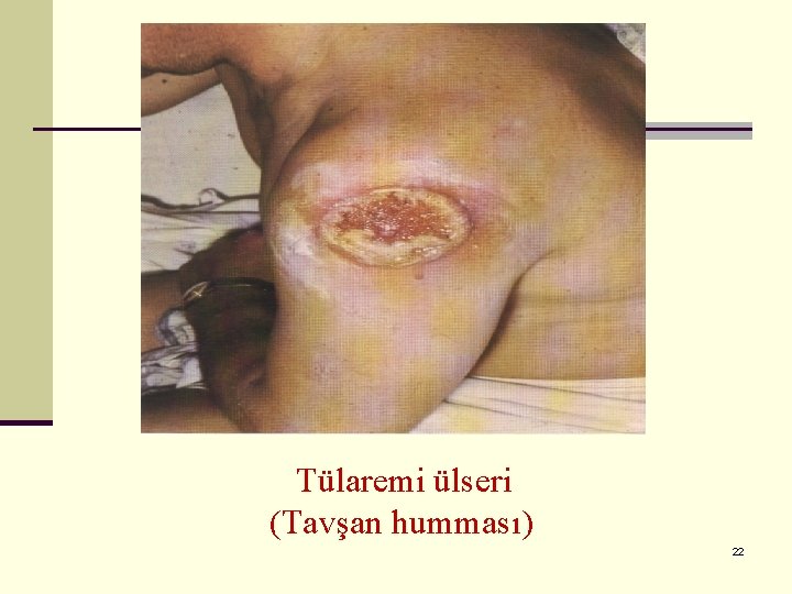 Tülaremi ülseri (Tavşan humması) 22 