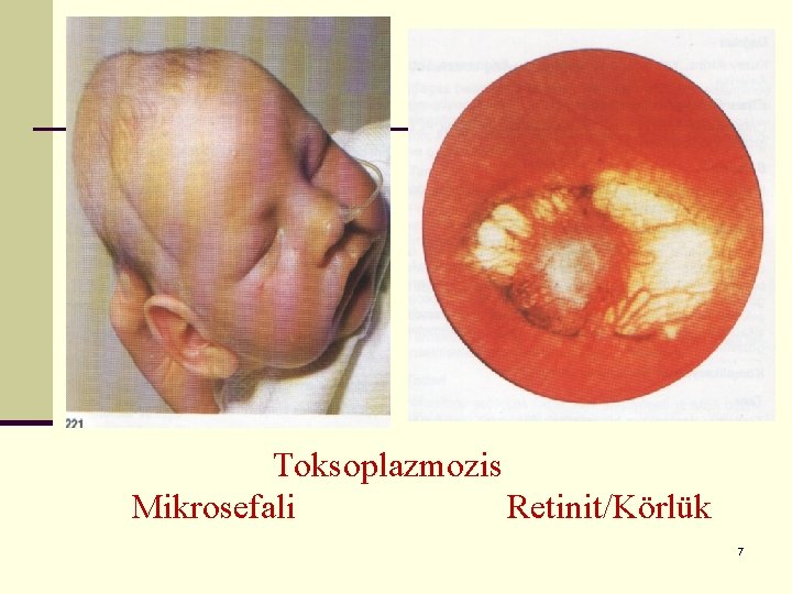 Toksoplazmozis Mikrosefali Retinit/Körlük 7 