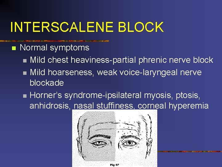 INTERSCALENE BLOCK n Normal symptoms n Mild chest heaviness-partial phrenic nerve block n Mild