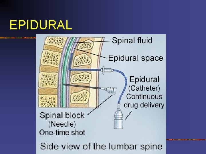 EPIDURAL 