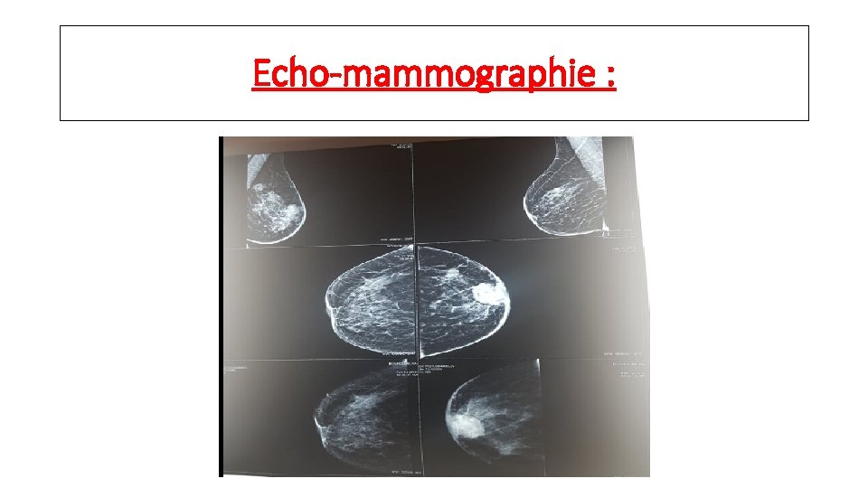 Echo-mammographie : 