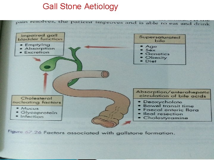Gall Stone Aetiology 