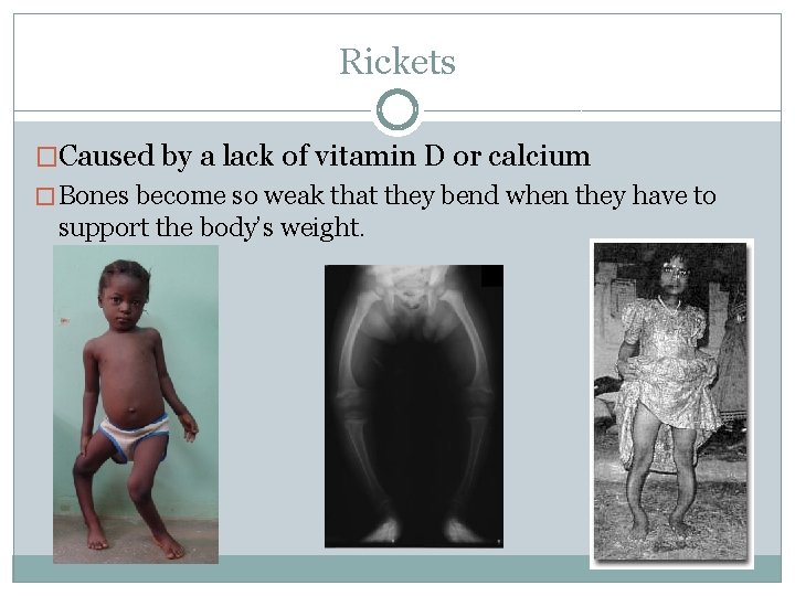 Rickets �Caused by a lack of vitamin D or calcium � Bones become so