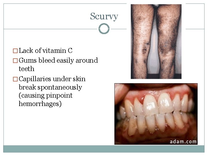 Scurvy � Lack of vitamin C � Gums bleed easily around teeth � Capillaries