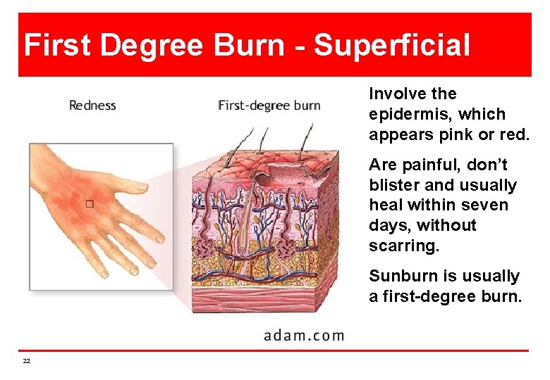 First Degree Burn - Superficial Involve the epidermis, which appears pink or red. Are